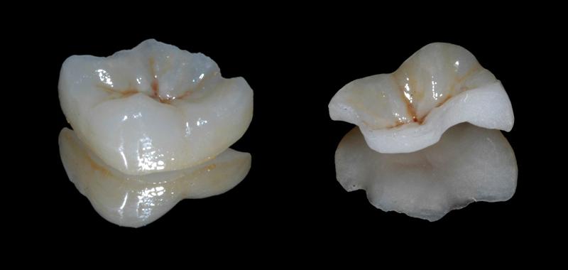 onlays prothèse fixe restauration unitaire