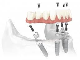 prothése complète fixe sur implant 2